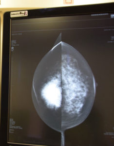 マンモグラフィーによる診断画像。左側の白い部分が乳がん組織